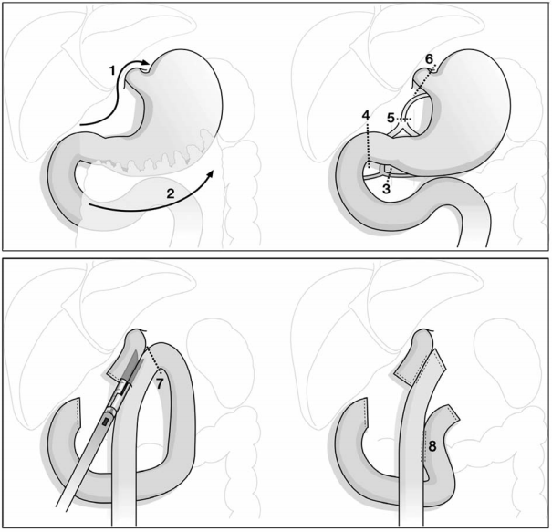 laparoscopic minimally invasive total gastrectomy