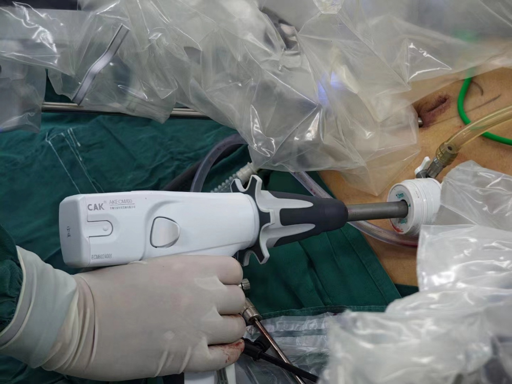 DAVINCI & CAK Staplers in Laparoscopic GI and Bariatric Surgery Demos